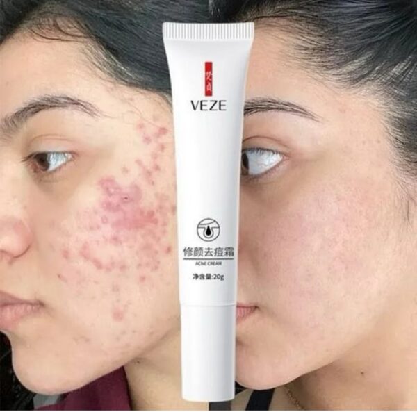 2025/11/1001079159.jpg Crema antiacné VEZE.